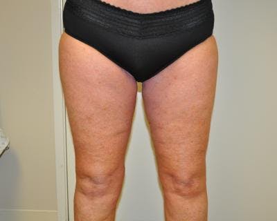 Thigh Lift Before & After Gallery - Patient 120354190 - Image 2