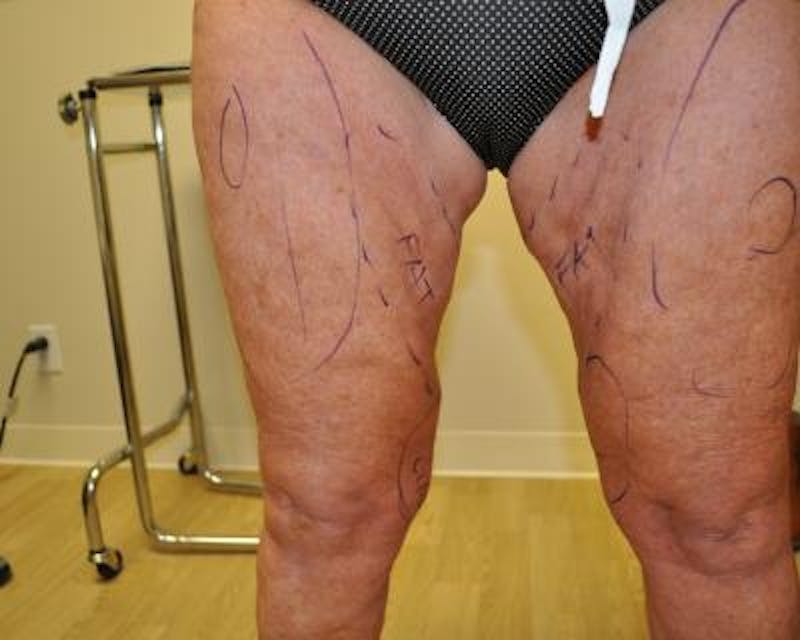 Thigh Lift Gallery - Patient 120354190 - Image 3