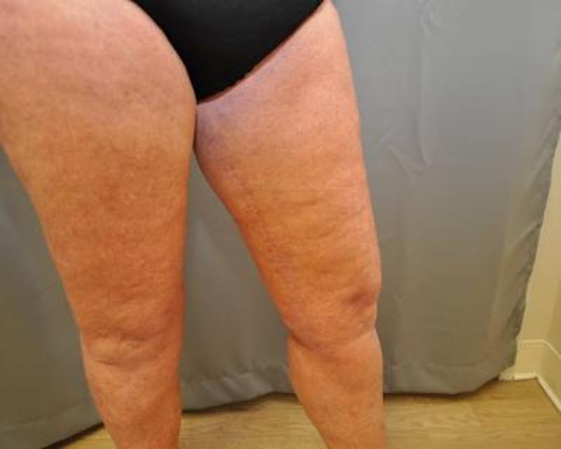 Thigh Lift Before & After Gallery - Patient 120354190 - Image 4