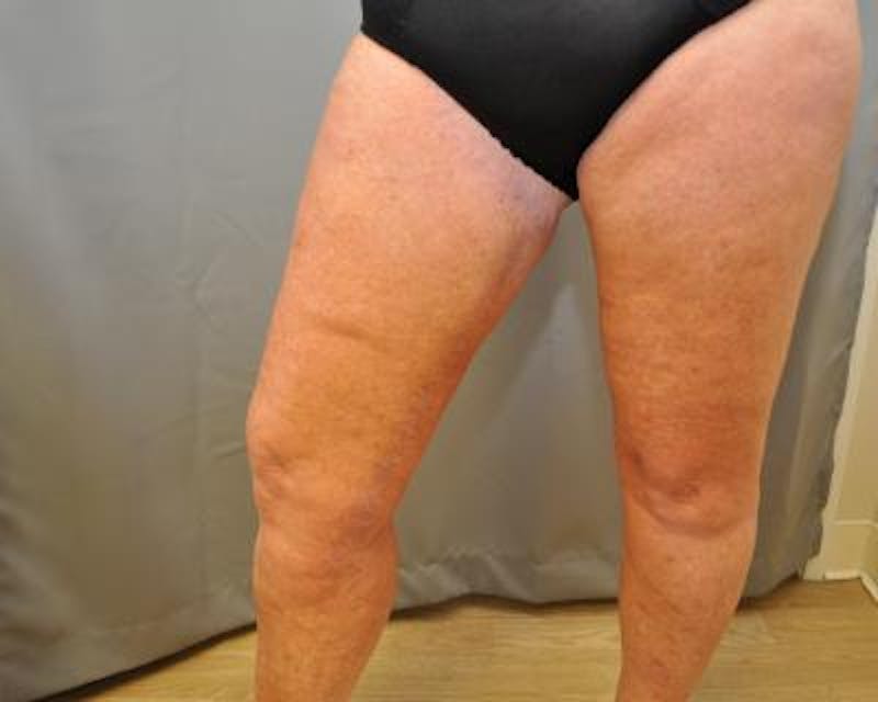 Thigh Lift Before & After Gallery - Patient 120354190 - Image 6