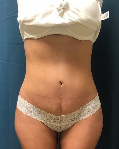 Emsculpt Before & After Gallery - Patient 120354249 - Image 2
