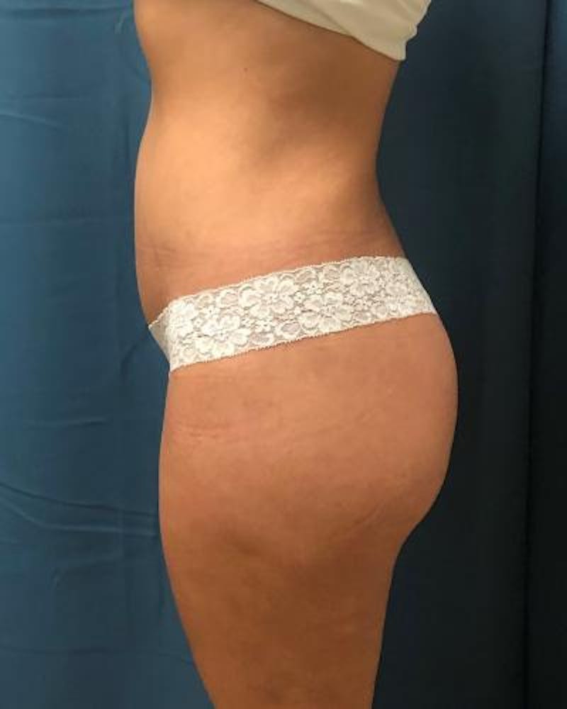Emsculpt Before & After Gallery - Patient 120354249 - Image 8