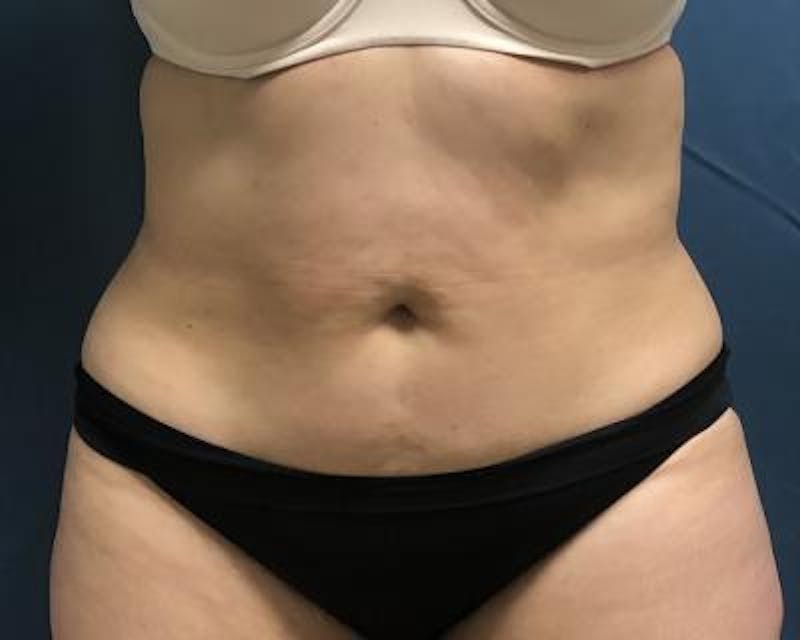 Emsculpt Before & After Gallery - Patient 120354250 - Image 1