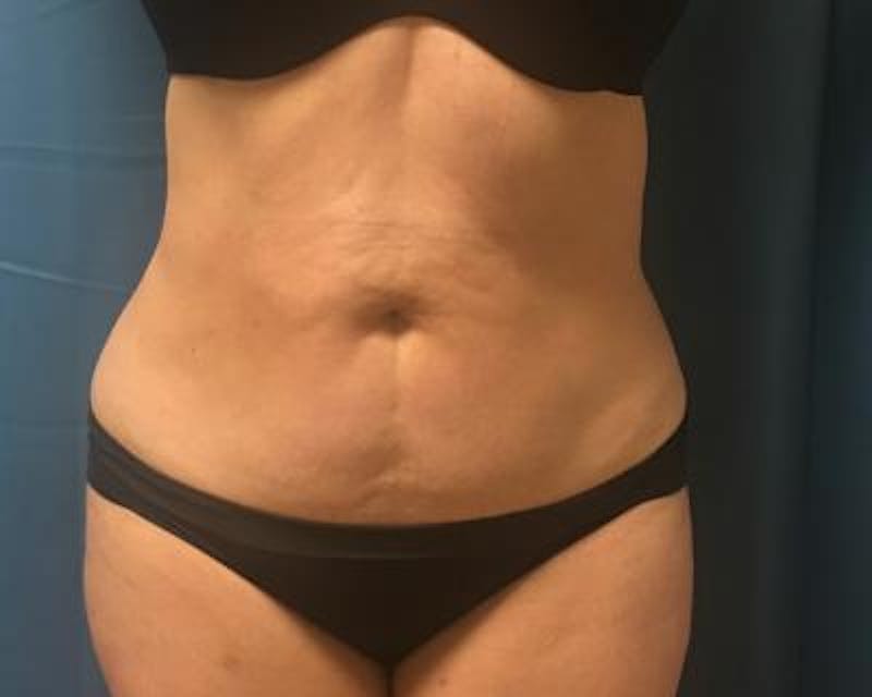 Emsculpt Before & After Gallery - Patient 120354250 - Image 2