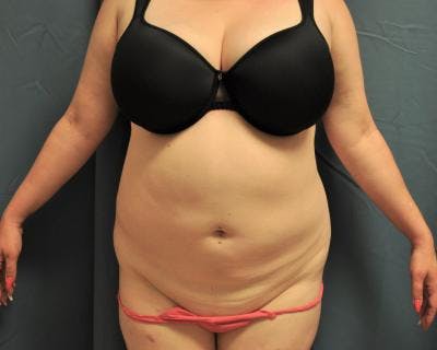 Emsculpt Before & After Gallery - Patient 120354251 - Image 1