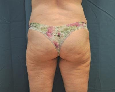 Emsculpt Before & After Gallery - Patient 120354255 - Image 1