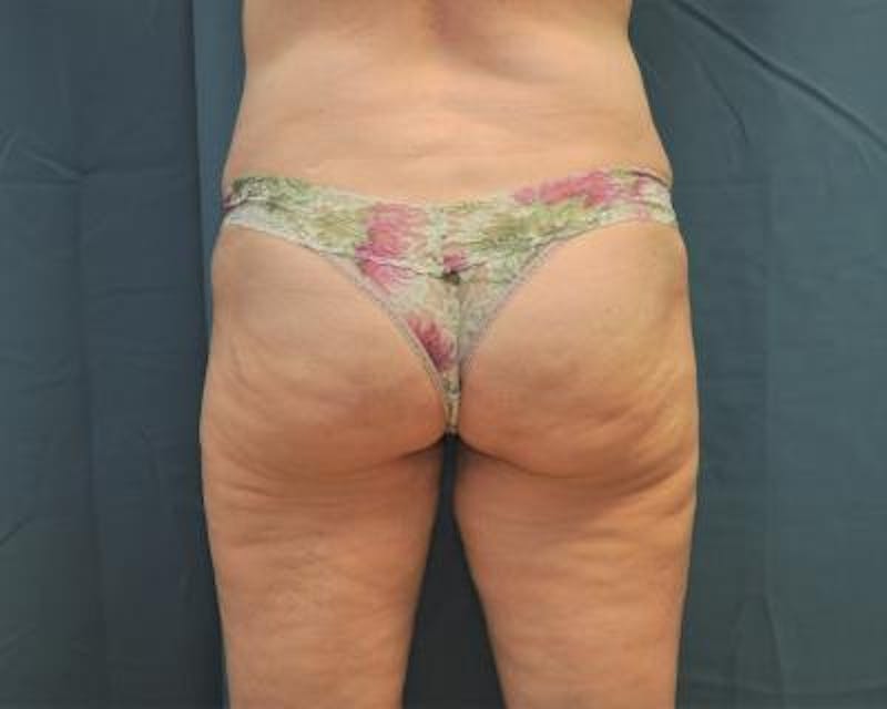 Emsculpt Before & After Gallery - Patient 120354255 - Image 1