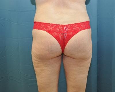 Emsculpt Before & After Gallery - Patient 120354255 - Image 2