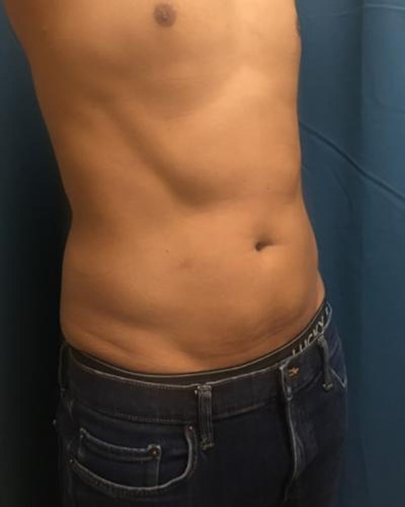 Emsculpt Before & After Gallery - Patient 120354255 - Image 6