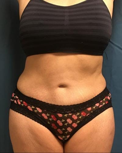 Emsculpt Before & After Gallery - Patient 120354264 - Image 2