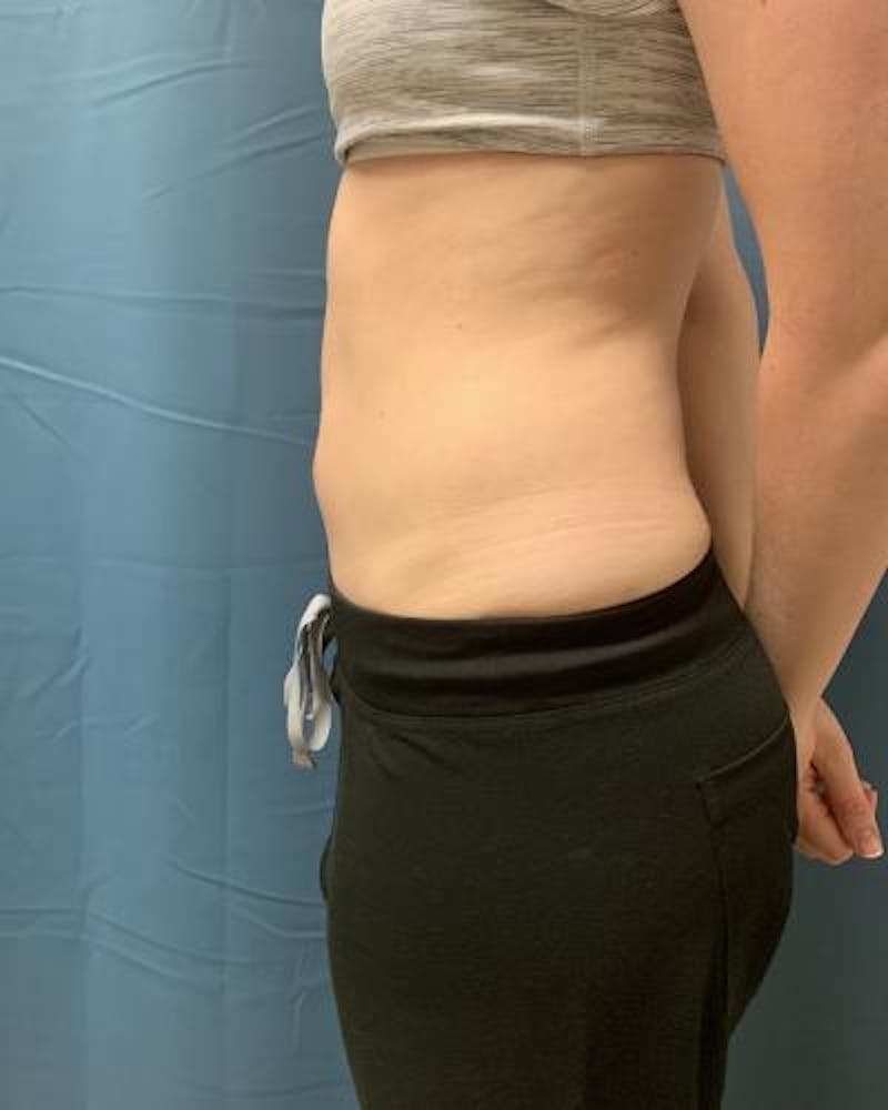 Emsculpt Before & After Gallery - Patient 120354264 - Image 7