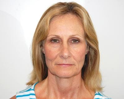 Facelift Before & After Gallery - Patient 120377400 - Image 1