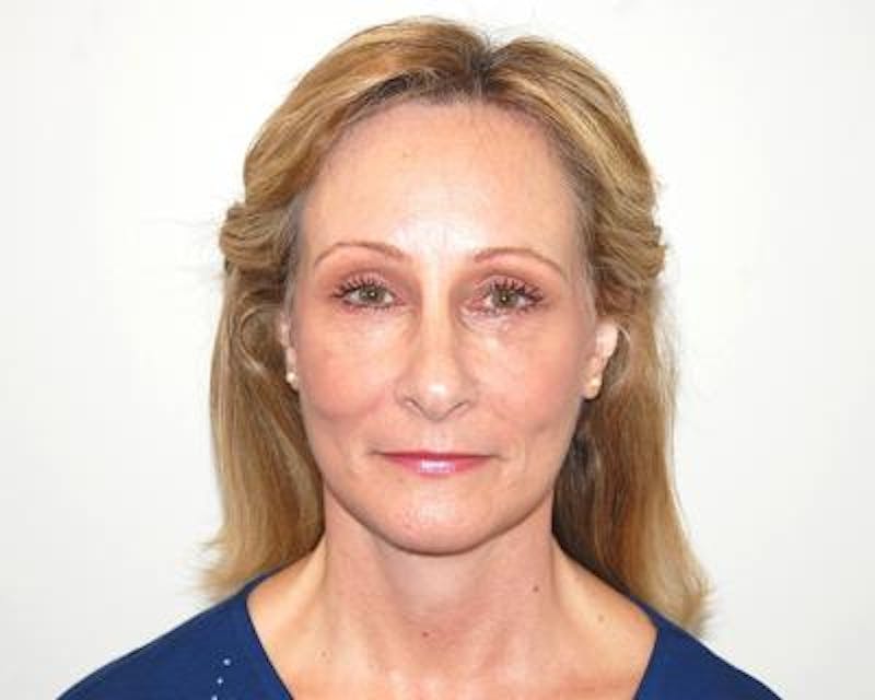 Facelift Before & After Gallery - Patient 120377400 - Image 2