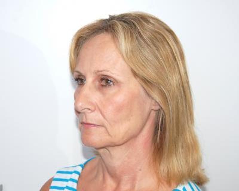 Facelift Before & After Gallery - Patient 120377400 - Image 3