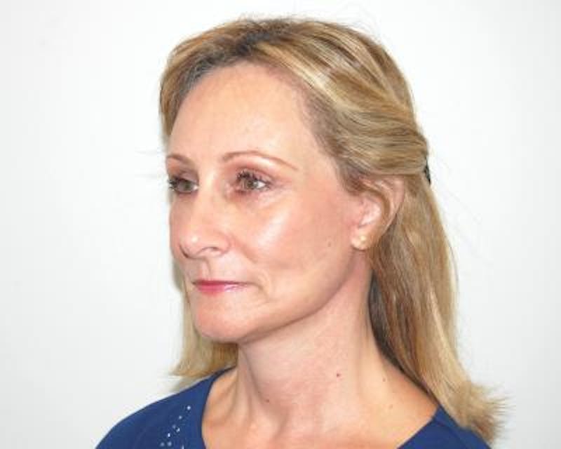 Facelift Before & After Gallery - Patient 120377400 - Image 4