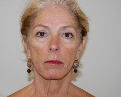 Facelift Before & After Gallery - Patient 120377402 - Image 1