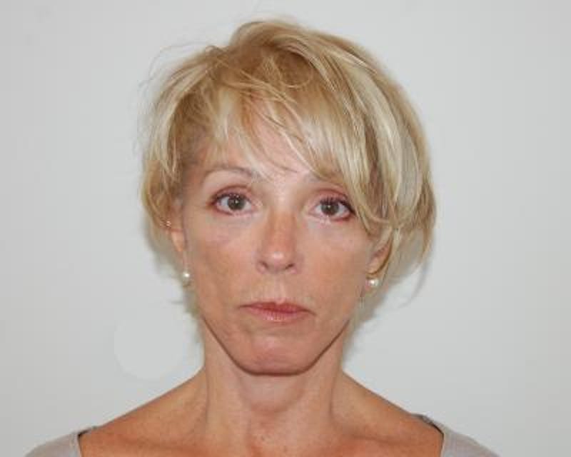 Facelift Before & After Gallery - Patient 120377402 - Image 2