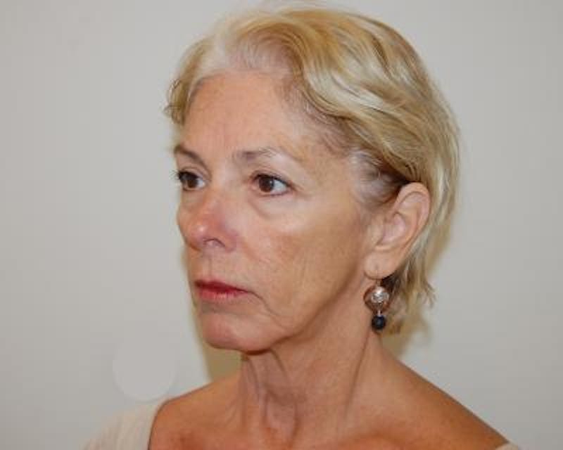 Facelift Before & After Gallery - Patient 120377402 - Image 3