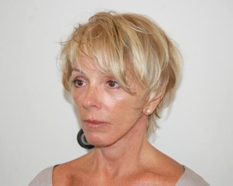 Facelift Before & After Gallery - Patient 120377402 - Image 4