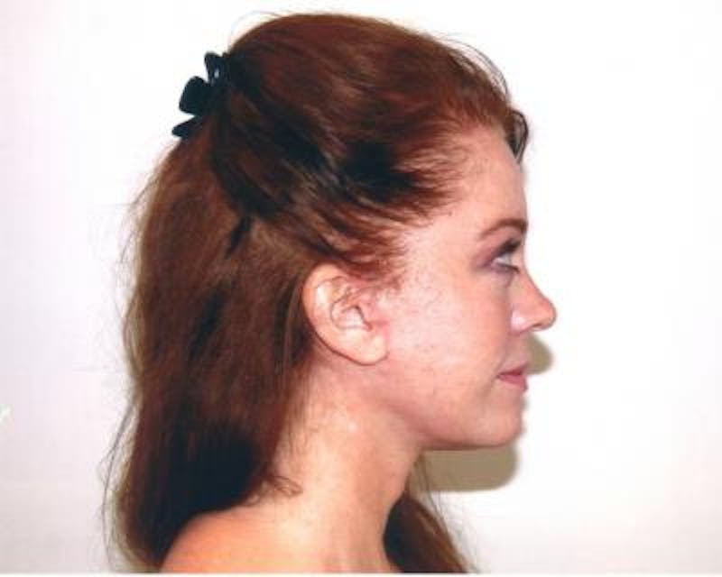 Necklift Before & After Gallery - Patient 159263374 - Image 4