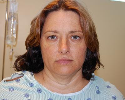 Facelift Before & After Gallery - Patient 120377410 - Image 1