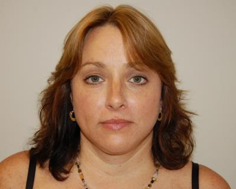 Necklift Before & After Gallery - Patient 159263375 - Image 2