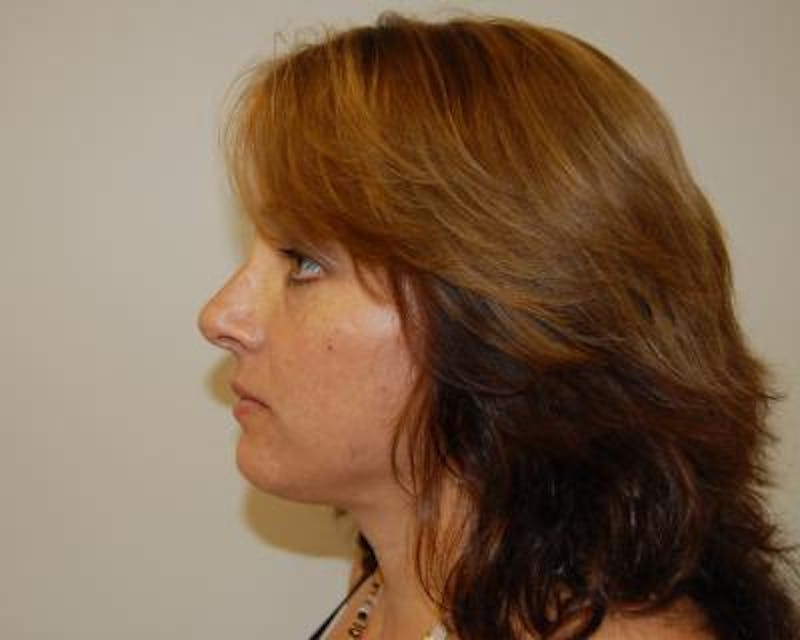 Necklift Before & After Gallery - Patient 159263375 - Image 4