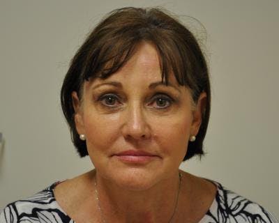Facelift Before & After Gallery - Patient 120377412 - Image 1