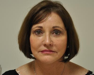 Facelift Before & After Gallery - Patient 120377412 - Image 2