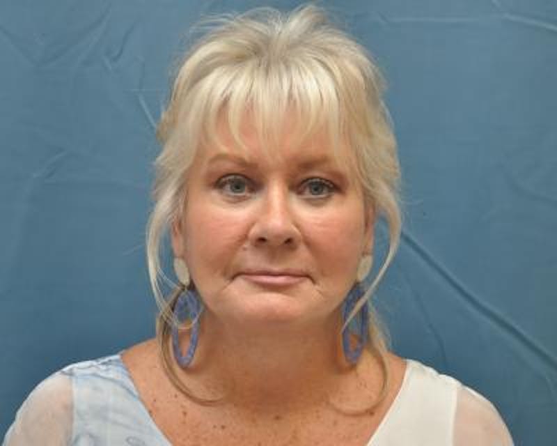Blepharoplasty Before & After Gallery - Patient 120377416 - Image 2