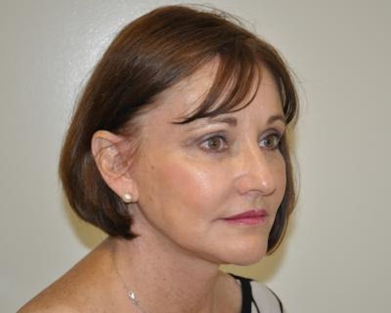 Facelift Before & After Gallery - Patient 120377412 - Image 4