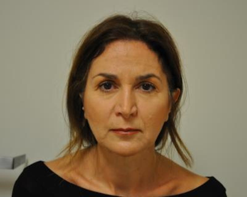 Facelift Before & After Gallery - Patient 120377420 - Image 1