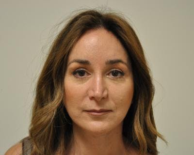 Facelift Before & After Gallery - Patient 120377420 - Image 2