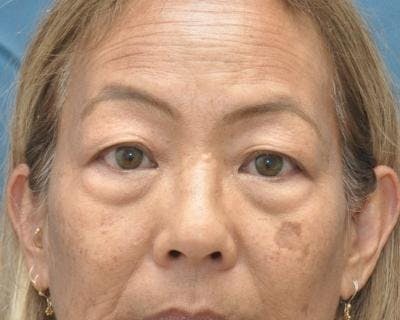 Blepharoplasty Before & After Gallery - Patient 120377421 - Image 1