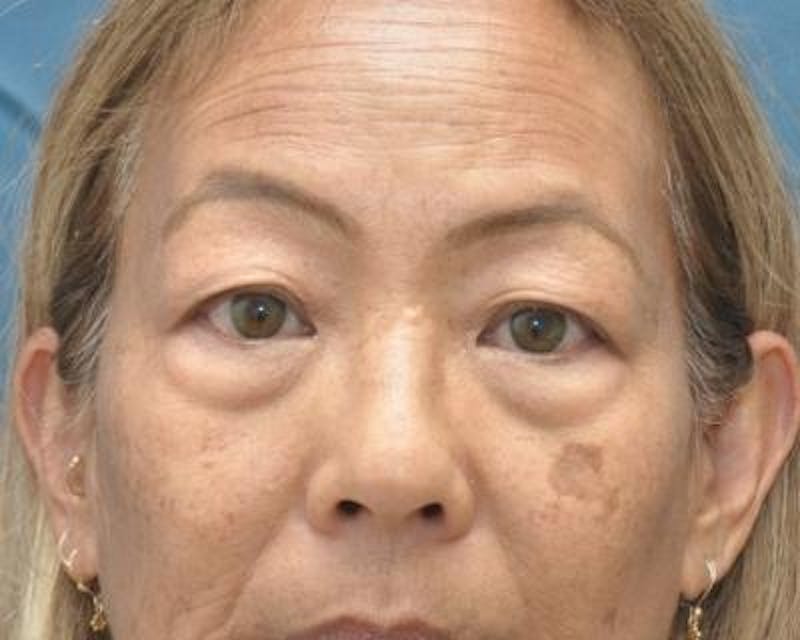 Eyelid Surgery