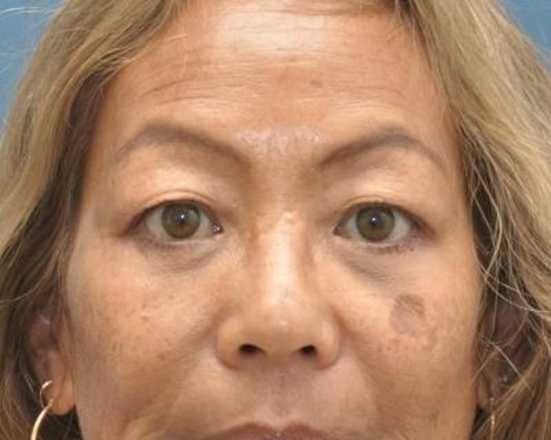 Blepharoplasty Before & After Gallery - Patient 120377421 - Image 2