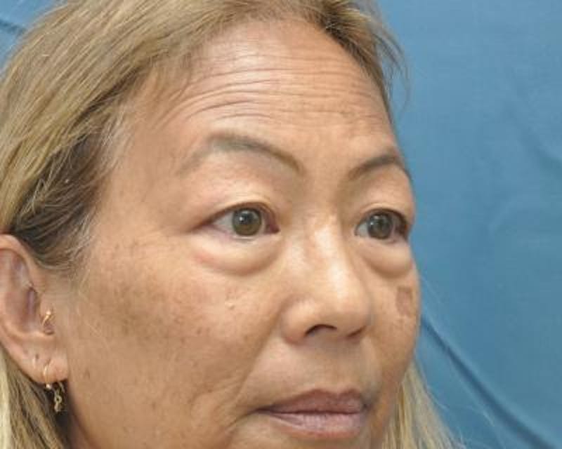 Blepharoplasty Before & After Gallery - Patient 120377421 - Image 3