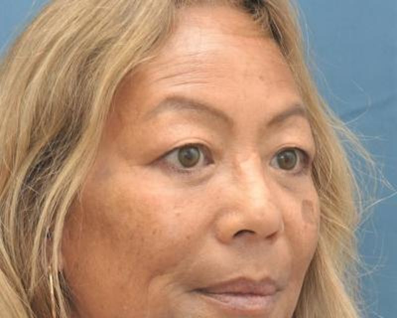Blepharoplasty Before & After Gallery - Patient 120377421 - Image 4