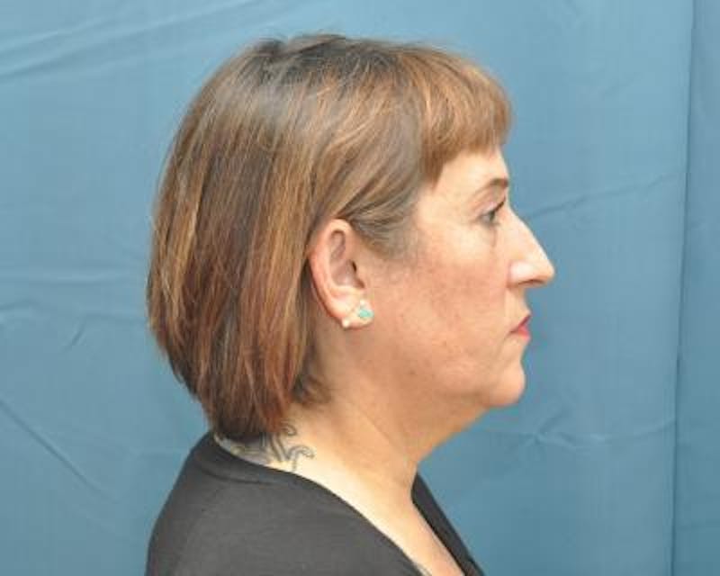 Facelift Before & After Gallery - Patient 120377424 - Image 3