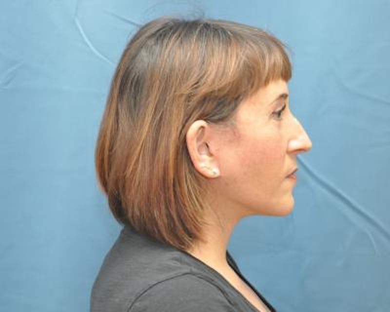 Facelift Before & After Gallery - Patient 120377424 - Image 4