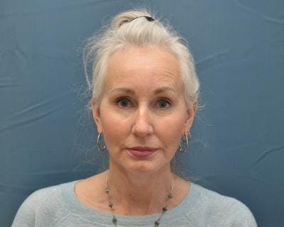 Facelift Before & After Gallery - Patient 120377428 - Image 2