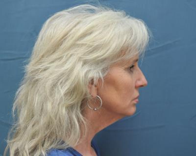 Facelift Before & After Gallery - Patient 120377428 - Image 3