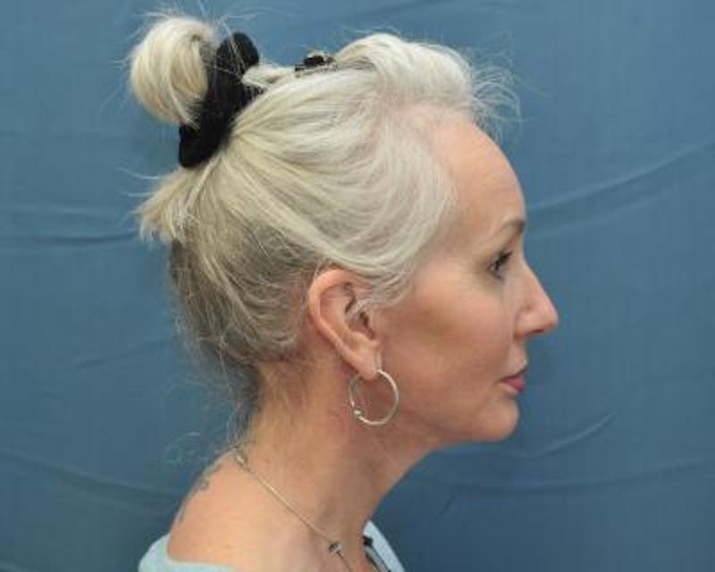Necklift Before & After Gallery - Patient 159263379 - Image 4