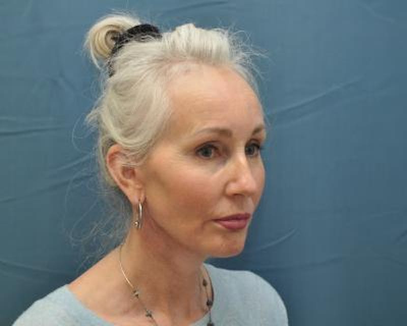 Facelift Before & After Gallery - Patient 120377428 - Image 6
