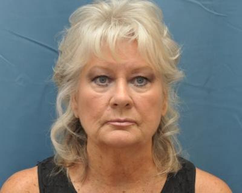 Facelift Before & After Gallery - Patient 120377438 - Image 1