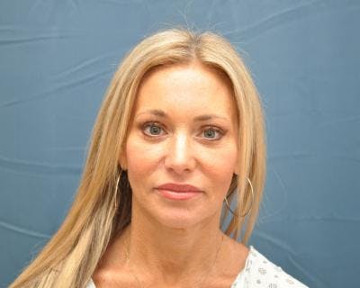 Blepharoplasty Before & After Gallery - Patient 120377437 - Image 2