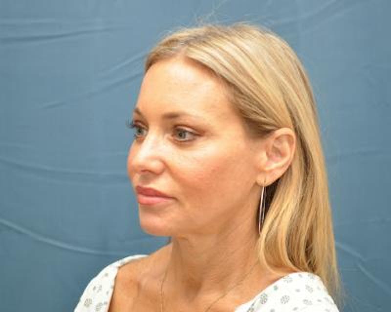 Blepharoplasty Before & After Gallery - Patient 120377437 - Image 4