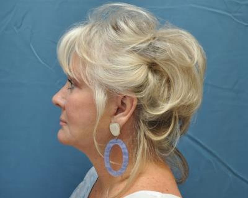 Facelift Before & After Gallery - Patient 120377438 - Image 6