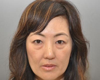 Blepharoplasty Before & After Gallery - Patient 120377441 - Image 1