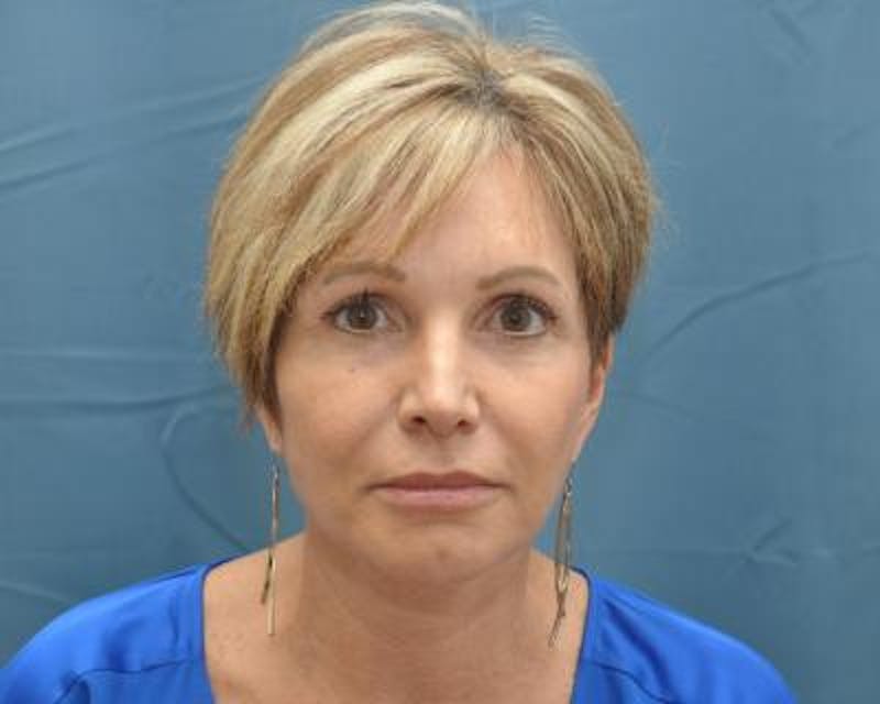 Facelift Before & After Gallery - Patient 120377442 - Image 2